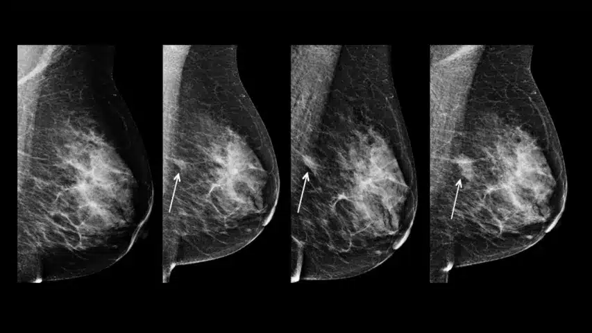 what does breast cancer look like on a mammogram?