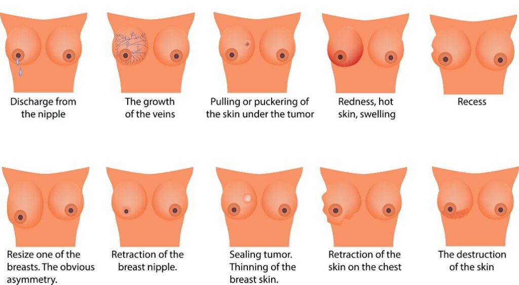 breast cancer skin changes pictures. it's important to see your doctor if you notice any changes to the skin on or around your breast.